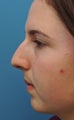 Rhinoplasty