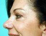 Botox for Crow's feet