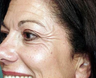 Botox for Crow's feet