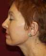 Facelift