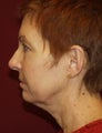 Facelift