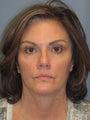 Brow Lift on 52-year-old