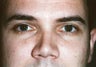 Blepharoplasty
