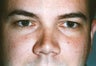 Blepharoplasty