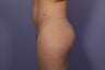 Butt augmentation
