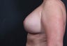 40 year old female with revision of breast augmentation and revision of breast lift