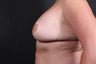 40 year old female with revision of breast augmentation and revision of breast lift
