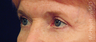 Eyelid Surgery - Blepharoplasty