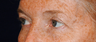 Eyelid Surgery - Blepharoplasty