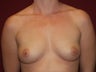 Breast Implants