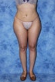 Brazilian Butt Lift