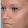 18 Year-Old Female Treated For Midface Deficiency