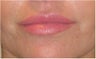 Lip Augmentation