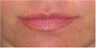 Lip Augmentation