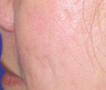 Mesotherapy