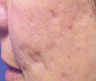 Mesotherapy