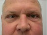 Eyelid Surgery