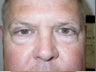 Eyelid Surgery