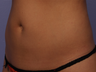 CoolSculpting by Zeltiq to Abdomen