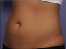 CoolSculpting by Zeltiq to Abdomen