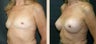 Breast Augmentation