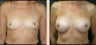 Breast Augmentation