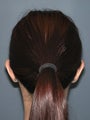 Otoplasty/Ear Surgery