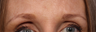 Botox