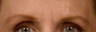 Botox