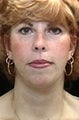 Facelift