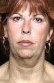 Facelift
