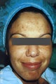 Hispanic woman 30-40 year old treated for Melasma and Acne Scars