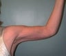 Female patient who had an arm lift 