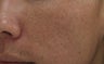 Fraxel repair CO2 laser resurfacing for acne scars