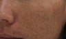 Fraxel repair CO2 laser resurfacing for acne scars