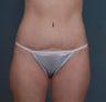 Tummy Tuck