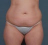 Tummy Tuck