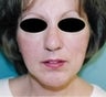 Female patient who underwent a chin implant 