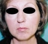Female patient who underwent a chin implant 
