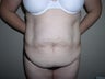 Tummy Tuck