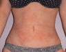 Liposuction