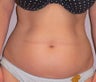 Liposuction