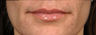 Restylane