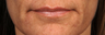 Restylane