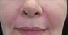 Juvederm