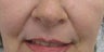 Juvederm