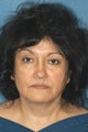 Women's Face Lift