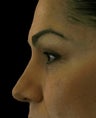 Hyaluronic acid fillers to lower lids and mid face
