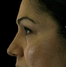 Hyaluronic acid fillers to lower lids and mid face