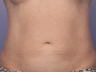 CoolSculpting by Zeltiq to Abdomen